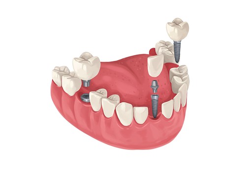 Implantologia Dentale Arcata Inferiore